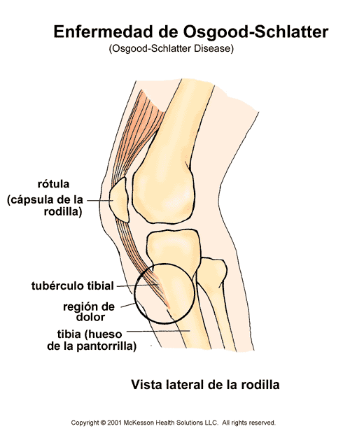 Enfermedad de Osgood-Schlatter: ilustracin