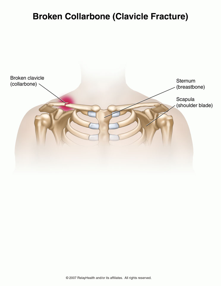 Broken Collarbone: Illustration