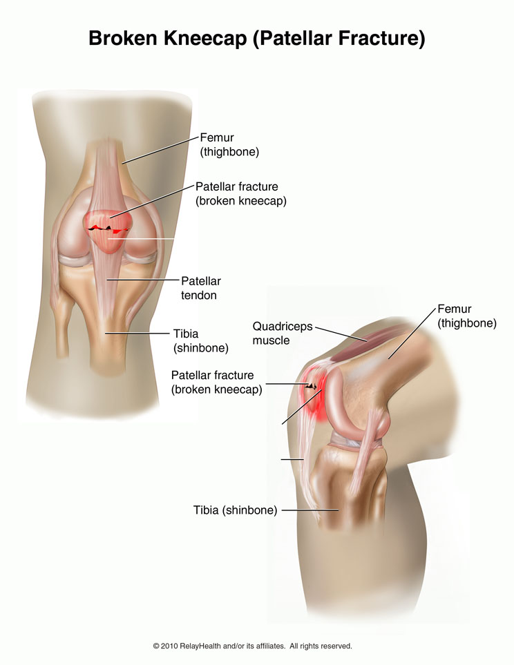 Broken Kneecap: Illustration