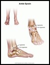 Thumbnail image of: Ankle Sprain: Illustration