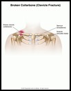 Thumbnail image of: Broken Collarbone: Illustration