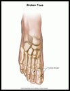 Thumbnail image of: Broken Toe: Illustration