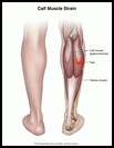 Thumbnail image of: Calf Strain: Illustration
