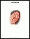 Thumbnail image of: Cauliflower Ear: Illustration