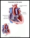 Thumbnail image of: Coarctation of the Aorta: Illustration