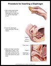 Thumbnail image of: Diaphragm, How to Insert: Illustration