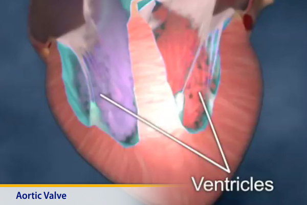 Thumbnail image of: Aortic Valve