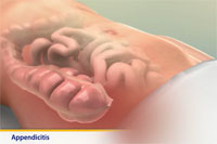 Thumbnail image of: Appendicitis (pediatric)