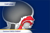 Thumbnail image of: Common cold (pediatric)