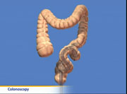 Thumbnail image of: Colonoscopy (pediatric)