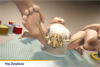 Thumbnail image of: Developmental Dysplasia of the Hip (pediatric)