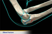 Thumbnail image of: Elbow Fracture (Olecranon Fracture) (pediatric)