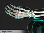 Thumbnail image of: Finger Fracture (pediatric)