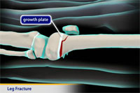 Thumbnail image of: Leg Fracture (pediatric)
