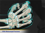 Thumbnail image of: Fifth Metacarpal Fracture (Boxer's Fracture) (pediatric)