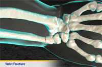 Thumbnail image of: Wrist Fracture (pediatric)