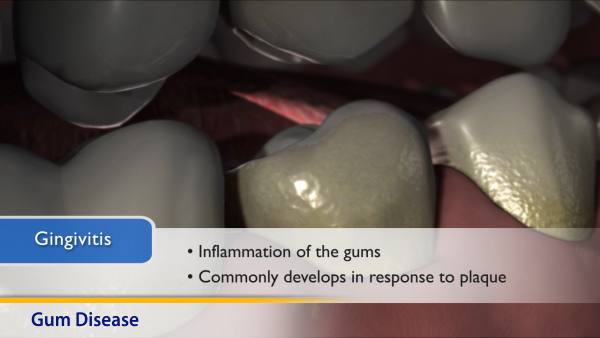 Thumbnail image of: Gum Disease