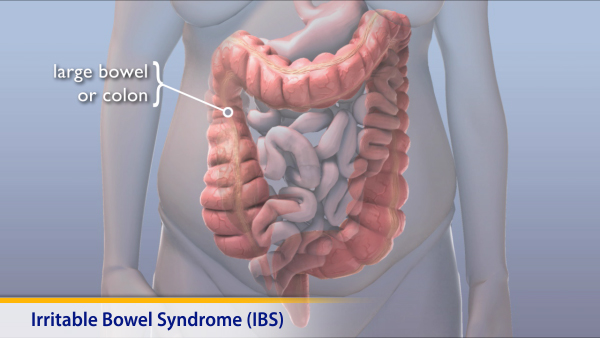 Thumbnail image of: Irritable Bowel Syndrome (IBS)