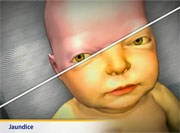 Thumbnail image of: Jaundice (pediatric)