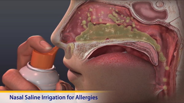 Thumbnail image of: Nasal Saline Irrigation for Allergies