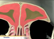 Thumbnail image of: Sinusitis