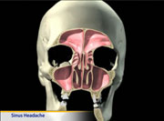 Thumbnail image of: Sinus Headaches