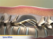 Thumbnail image of: Spina bifida (pediatric)