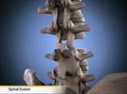 Thumbnail image of: Spinal Fusion