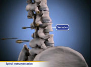 Thumbnail image of: Spinal Instrumentation
