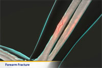 Thumbnail image of: Forearm Fracture (pediatric)