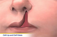 Thumbnail image of: Cleft Lip and Cleft Palate Surgery (pediatric)