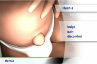 Thumbnail image of: Hernias (pediatric)