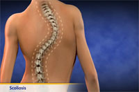 Thumbnail image of: Scoliosis (pediatric)
