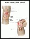 Thumbnail image of: Broken Kneecap: Illustration