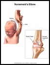 Thumbnail image of: Nursemaid's Elbow: Illustration