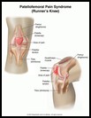 Thumbnail image of: Runner's Knee: Illustration