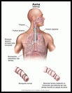 Thumbnail image of: Estrechamiento de los bronquiolos en el asma: ilustración