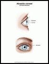Thumbnail image of: Abrasión corneal: ilustración
