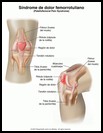 Thumbnail image of: Síndrome de dolor femorrotuliano: ilustración