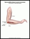 Thumbnail image of: Epicondilitis lateral: ilustración
