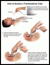 Thumbnail image of: Tracheostomy Tube, How to Suction: Illustration