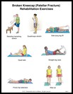 Thumbnail image of: Broken Kneecap Exercises, Page 1: Illustration