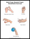 Thumbnail image of: Mallet Finger (Baseball Finger) Exercises: Illustration