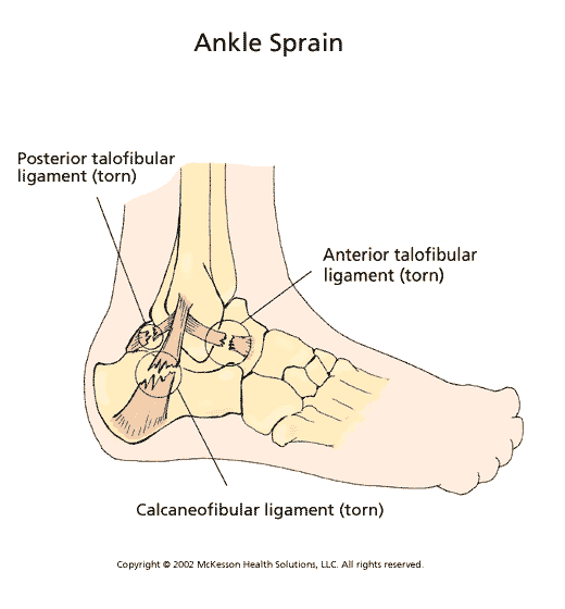 Ankle Sprain:  Illustration