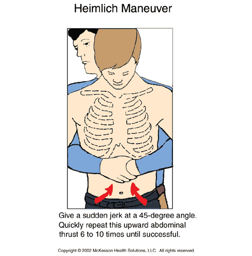 Heimlich Maneuver: Illustration