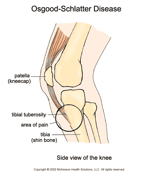 Osgood-Schlatter Disease:  Illustration