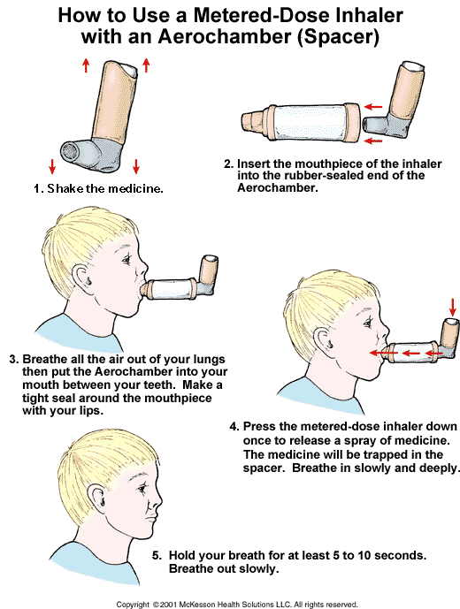How to Use a Metered-Dose Inhaler with an Aerochamber (Spacer): Illustration