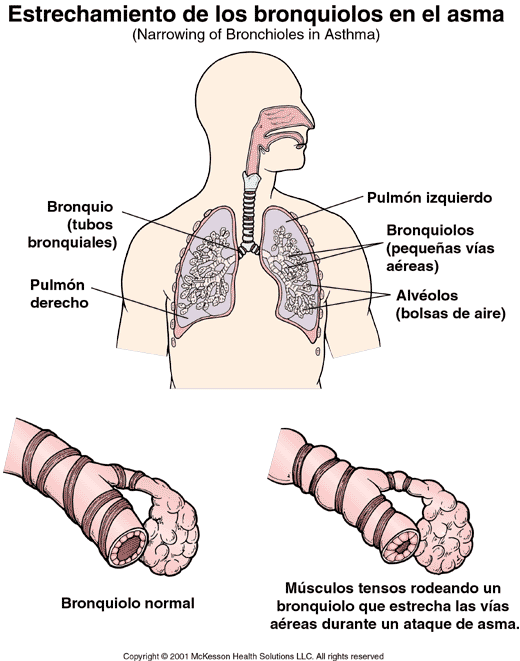 Estrechamiento de los bronquiolos en el asma: ilustracin