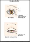 Thumbnail image of: Conjunctivitis: Illustration