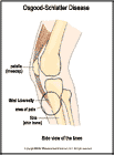 Thumbnail image of: Osgood-Schlatter Disease:  Illustration